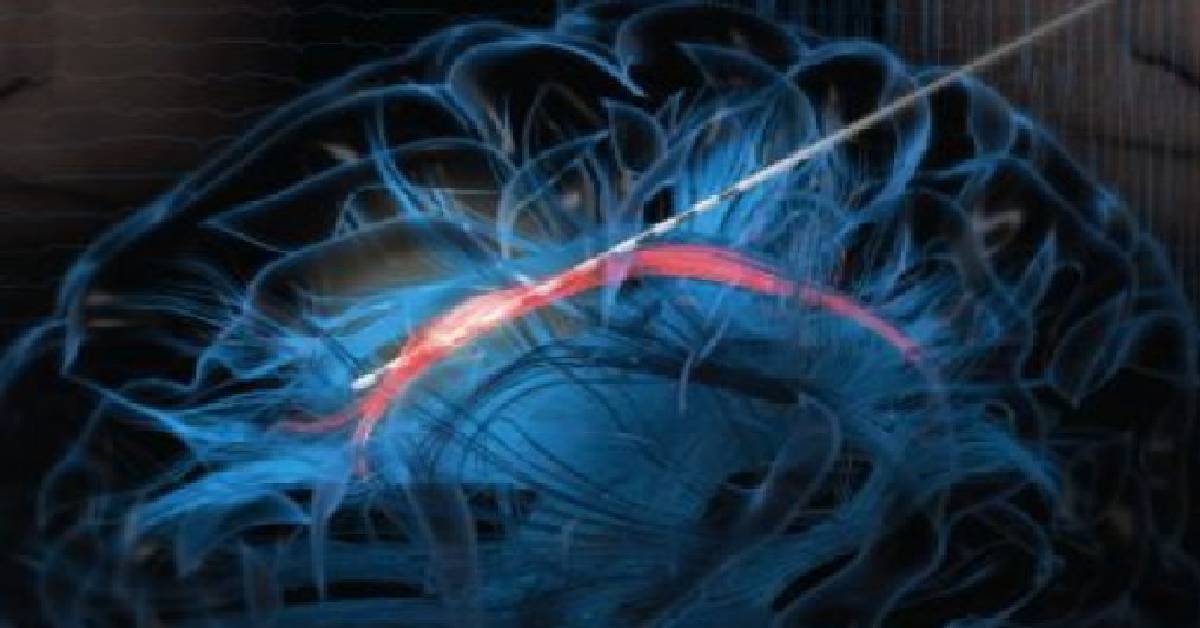 Laughter May Be the Best Medicine for Brain Surgery