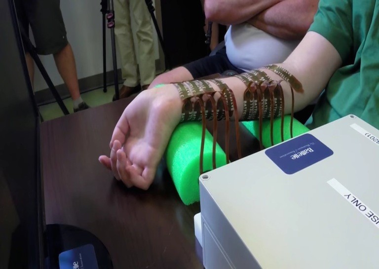 Brain Implant Restores Use of Paralyzed Man's Arm