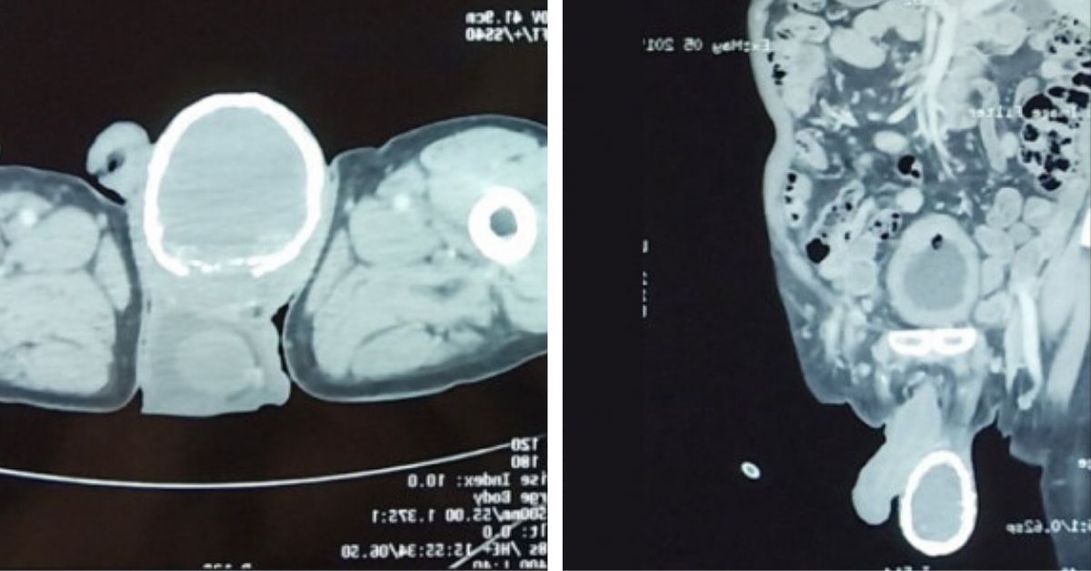 Doctors Discover Man's Enlarged Testicle Is Calcifying and Swimming in